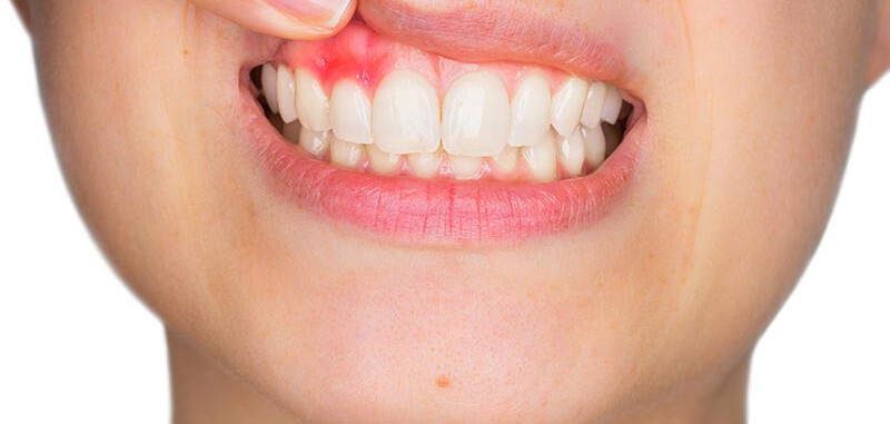 Các vấn đề về nướu răng: Đau, sưng và chảy máu