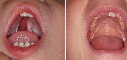 Khe hở vòm miệng: Nguyên nhân, chẩn đoán và điều trị