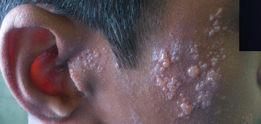 Herpes Zoster Oticus: Nguyên nhân, chẩn đoán và điều trị