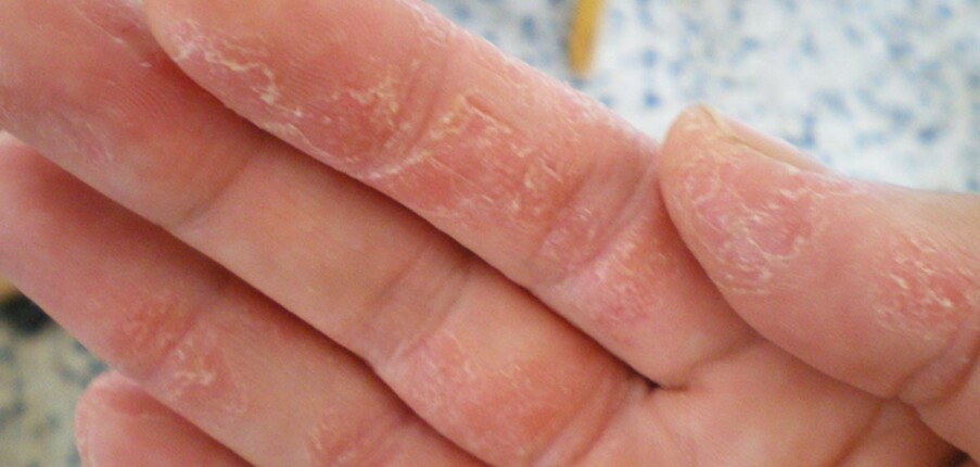 Bong tróc da tay: Nguyên nhân và biện pháp điều trị