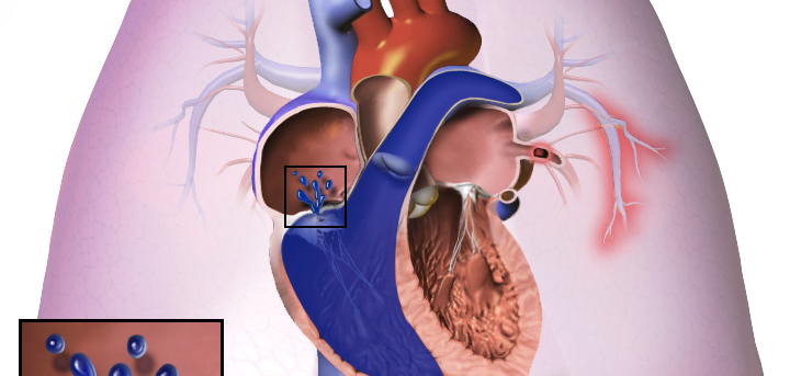 Tăng áp động mạch phổi: Nguyên nhân, triệu chứng, chẩn đoán và điều trị