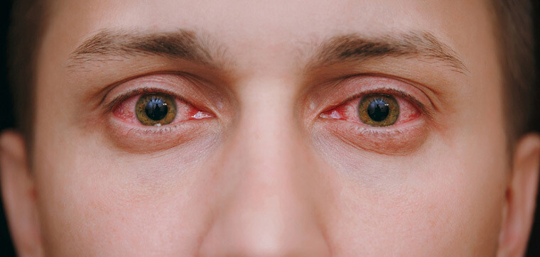 Sưng mắt: Nguyên nhân, triệu chứng, chẩn đoán và điều trị