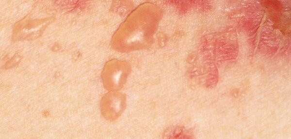 Pemphigus: một bệnh lý ngoài da nghiêm trọng