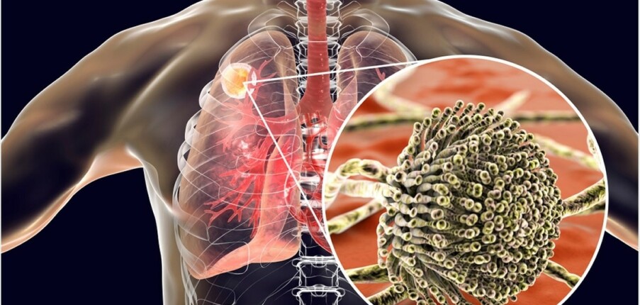 Nhiễm nấm phổi: ít gặp nhưng nguy hiểm