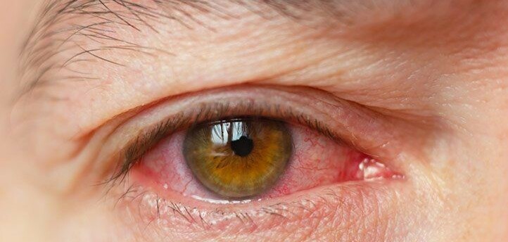 Khô mắt là gì? Triệu chứng, nguyên nhân và điều trị