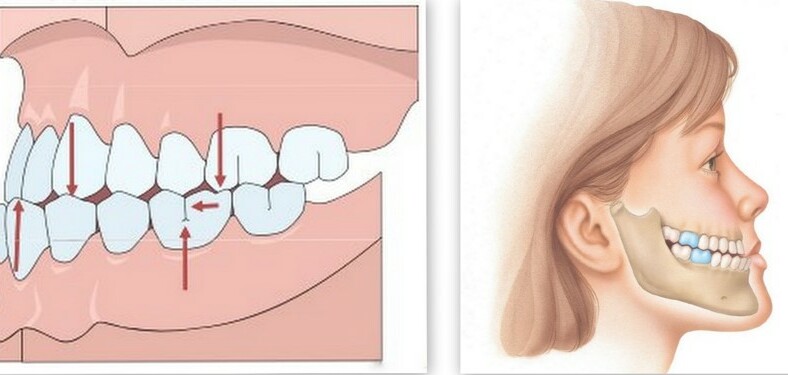 Khớp cắn ngược và những điều cần biết