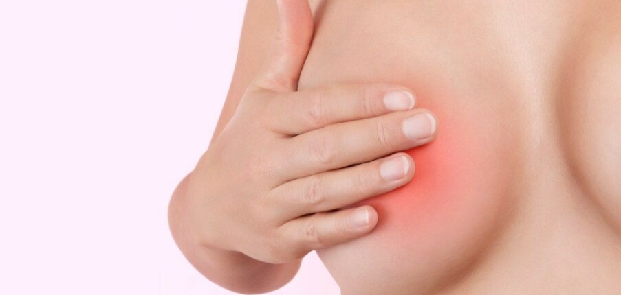 6 điều cần biết về viêm tuyến vú