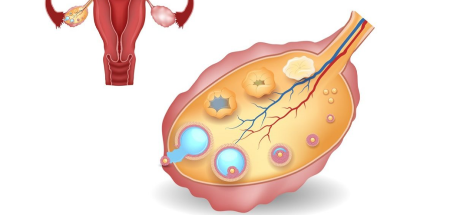 Chu kỳ không rụng trứng: Cách phát hiện và phương pháp điều trị