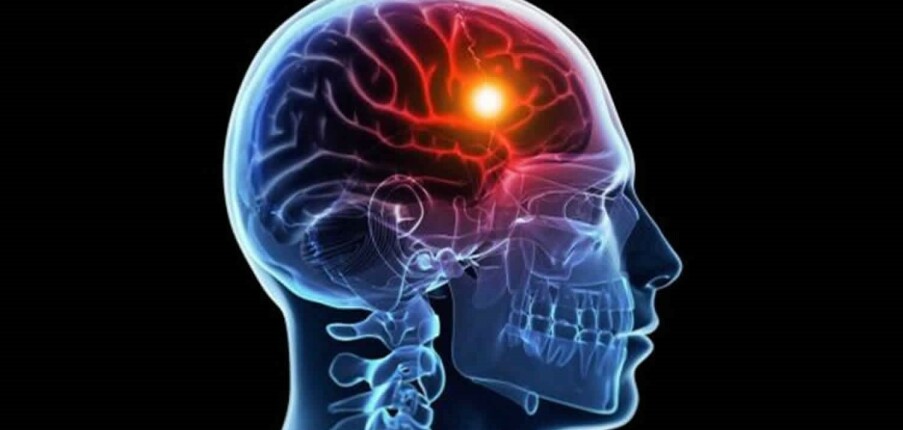 Thiếu oxy lên não: Nguyên nhân, triệu chứng, chẩn đoán, điều trị và phòng ngừa