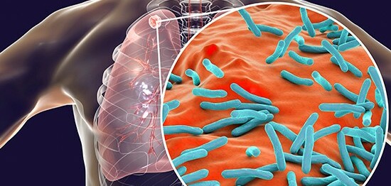 Trực khuẩn lao (Mycobacterium Tuberculosis): Những điều bạn cần biết