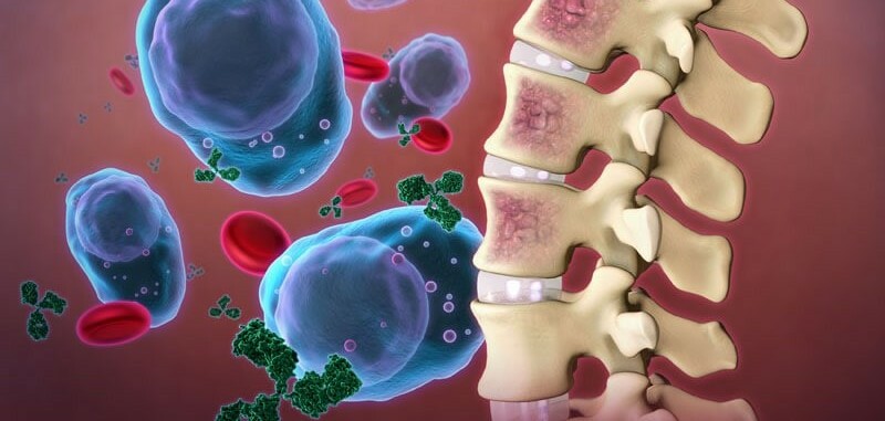 Bệnh đa u tủy xương: Triệu chứng, nguyên nhân và phương pháp điều trị