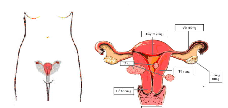 Đặc điểm của khí hư trong u xơ tử cung