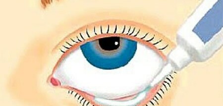 Thuốc Beoxid - Điều trị nhiễm trùng mắt - Hộp 1 tuýp x 5g - Cách dùng