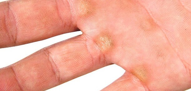 4 Nguyên nhân xuất hiện vết chai tay và cách điều trị