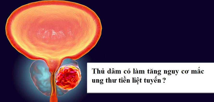 Thủ dâm và nguy cơ mắc ung thư tiền liệt tuyến