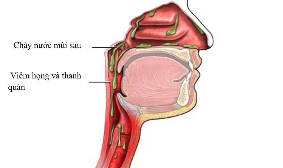 Hình minh họa chảy nước mũi sau (nguồn: https://commons.wikimedia.org/)  