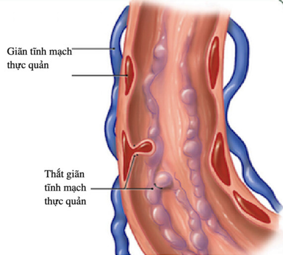 Giãn tĩnh mạch thực quản vỡ là một nguyên nhân của nôn ra máu