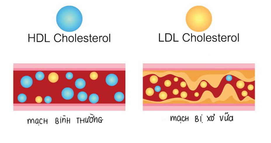 Chất béo bão hoà làm tăng cholesterol xấu, gây ra các mảng xơ vữa, nguồn ảnh avitahealth.org