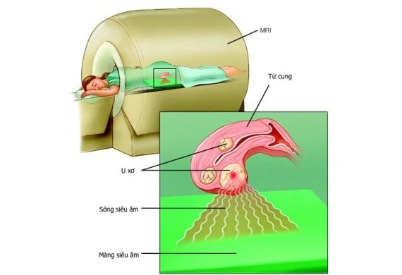 (Phẫu thuật siêu âm MRI - nguồn ảnh: Mayo Clinic)