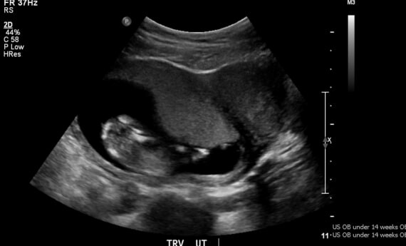 Hình ảnh thai qua siêu âm tuần thứ 13. Nguồn: ResearchGate