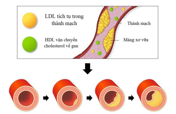 Hai loại cholesterol trong cơ thể (Nguồn ảnh: Dil Walk)