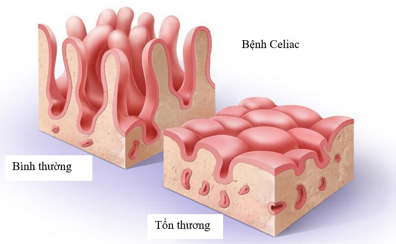 Viêm niêm mạc đường tiêu hoá gặp trong bệnh Celiac. Nguồn ảnh: NutritionwithCourtney.com