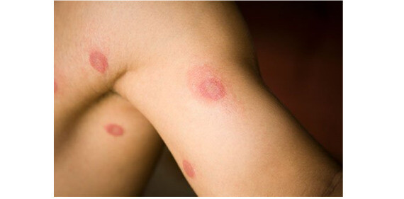 Tổn thương đặc trưng của bệnh hắc lào là hình tròn hoặc hình nhẫn, bờ đỏ nhô cao so với bề mặt da, vùng da phía trong tổn thương gần như bình thường (nguồn ảnh: https://www.medicinenet.com/) 