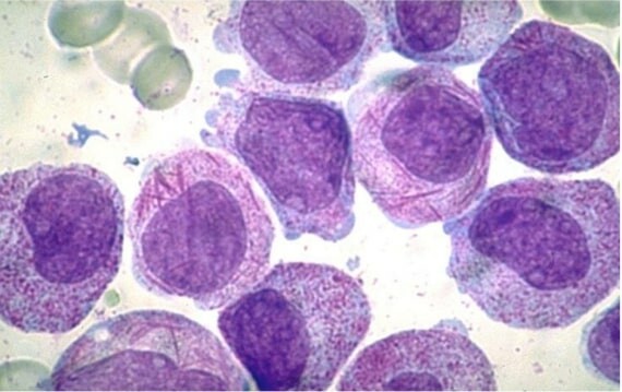 Hình ảnh tế bào blast tăng sinh trong dịch tủy xương. Nguồn: Slide Share