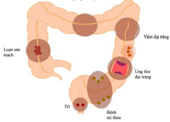 Nguyên nhân xuất huyết tiêu hoá thấp. Nguồn ảnh: www.pinterest