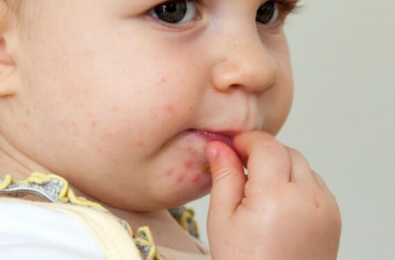 Trẻ mắc bệnh TCM thường có nổi phát ban và mụn nước ở quanh miệng, trong lòng bàn tay, lòng bàn chân.(nguồn: health.clevelandclinic.org)