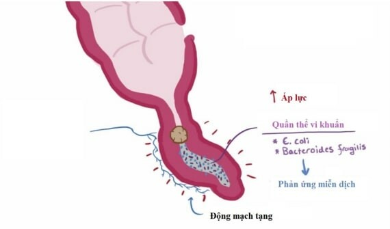 Viêm ruột thừa xảy ra khi đoạn ruột này bị tắc nghẽn bởi sỏi, giun, sán, phân,… - Nguồn ảnh: msdmanual.com