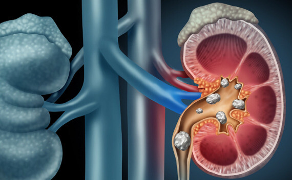 Theo keto trong một thời gian dài có thể dẫn đến sỏi thận. Nguồn ảnh: Cdi.org.in 