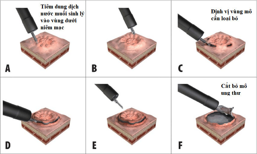 Kỹ thuật Cắt tách dưới niêm mạc qua nội soi– ESD (Endoscopic Submucosal Dissection) – Nguồn ảnh: researchgate.com 