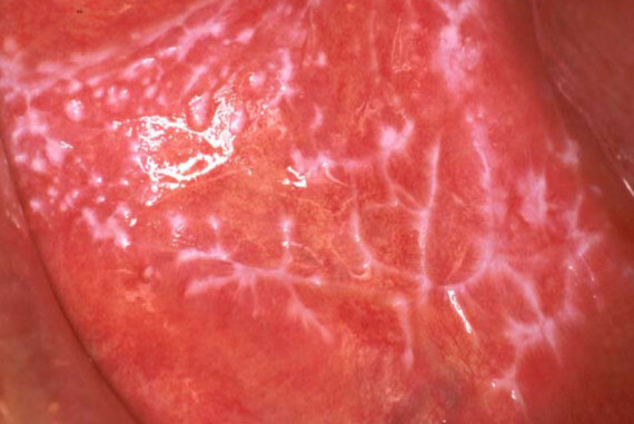 Bệnh lichen phẳng ở miệng là một tình trạng viêm có thể gây ra các ban màu trắng, có dạng lưới ren trong miệng.(nguồn: https://eaom.eu)