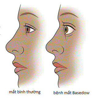 Biểu hiện lồi mắt trong bệnh mắt Basedow: Nguồn ảnh: homeopathicassociates.com