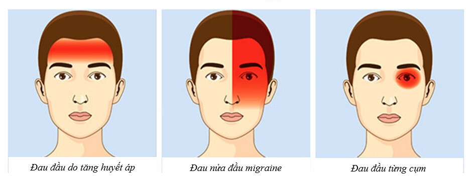 Phân biệt vị trí của một số loại đau đầu ( nguồn ảnh: https://www.painfreenyc.com/) 