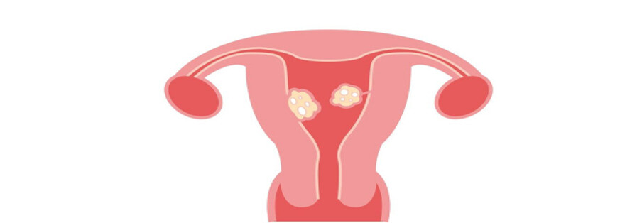 U xơ tử cung là sự tăng sinh của mô trong hoặc trên thành tử cung. U xơ tử cung là sự tăng sinh của mô trong hoặc trên thành tử cung. 