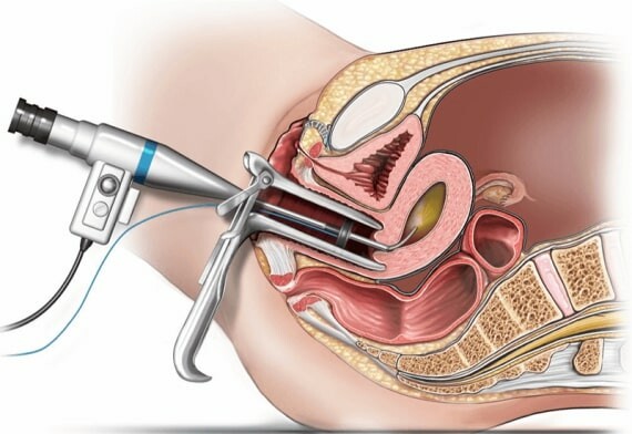 Hình ảnh miêu tả quá trình cắt bỏ nội mạc tử cung.Ảnh: Healthdirect.com