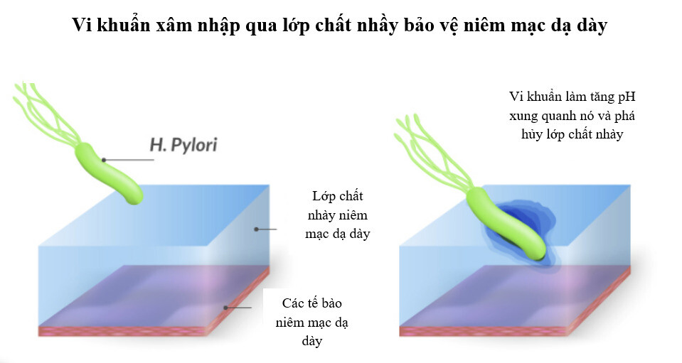 Cơ chế gây tổn thương dạ dày của H. pylori 