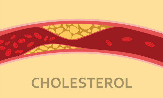 Mức cholesterol trong máu cao, tích tụ trong lòng mạch gây xơ vữa động mạch. Nguồn ảnh: Pinterest