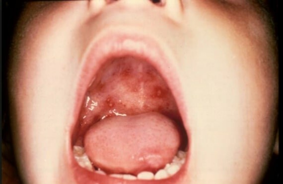 Mụn nước và vết loét trong miệng do bệnh TCM có thể gây đau cho người bệnh. (nguồn: doyouremember.com)