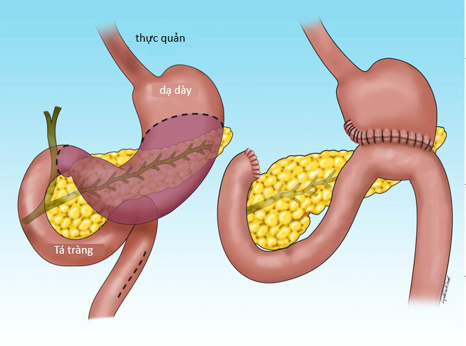 Phẫu thuật cắt 1 phần dạ dày giúp giảm xuất huyết và giảm đau (nguồn ảnh: usahealthsystem.com) 