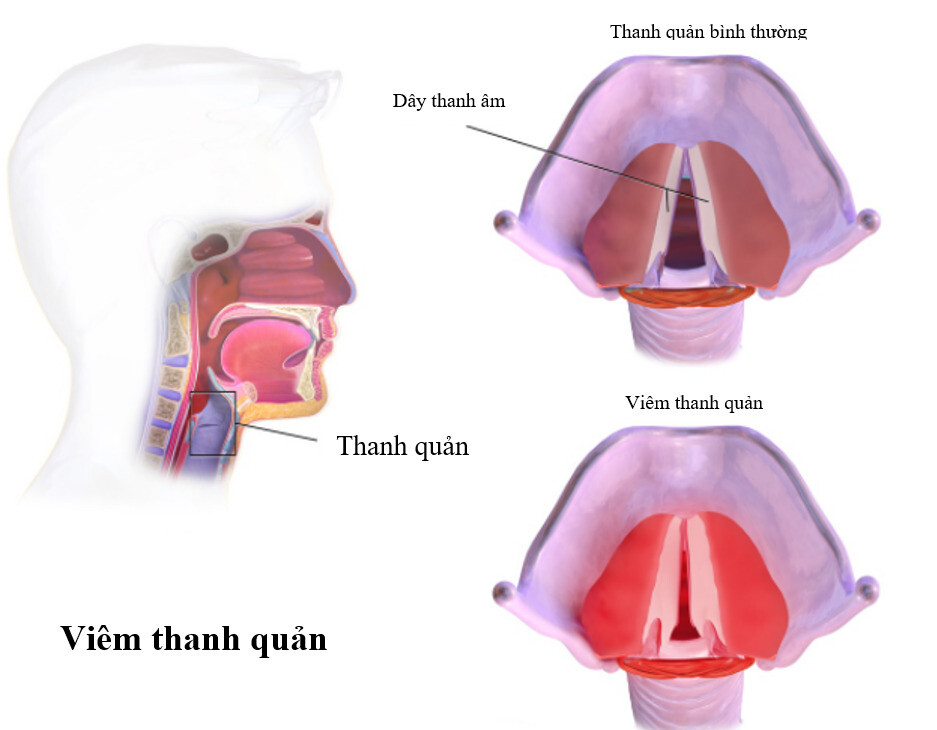 Sưng, phù nề trong thanh quản (nguồn: https://www.childnurture.com/) 