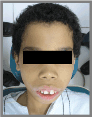 Gương mặt đặc trưng của bệnh nhân bị thalassemia, nguồn ảnh oatext.com 