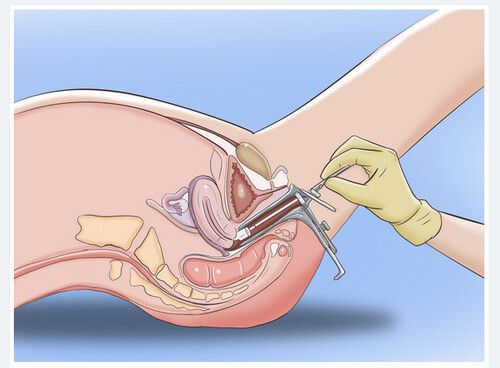 Thực hiện phết tế bào cổ tử cung (xét nghiệm Pap). Nguồn ảnh: www.indiamart.com