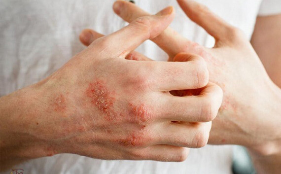 Bệnh eczema (bệnh chàm) 