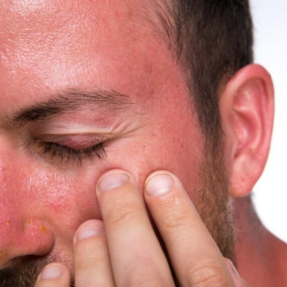 Đỏ mặt là một trong những tác dụng phụ khi dùng Vitamin B3