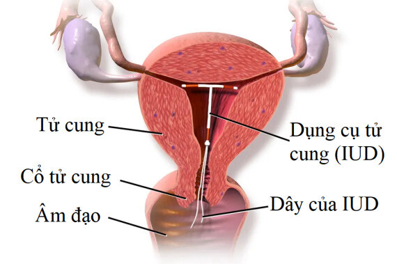 IUD vừa là biện pháp tránh thai khẩn cấp, vừa là biện pháp tránh thai lâu dài. Nguồn ảnh:https://www.theverge.com/