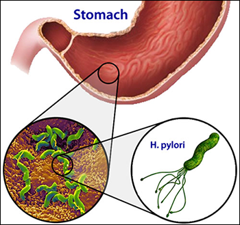 H. Pylori là nguyên nhân chính gây viêm loét dạ dày tá tràng (nguồn ảnh: https://www.alwaysayurveda.net/)  