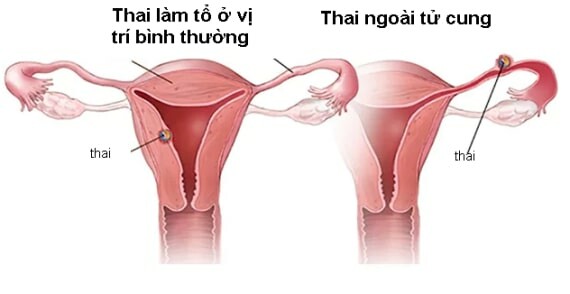 U xơ tử cung (Nguồn ảnh: Lecturio.com)